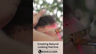 Natural Hairline in Hair Transplant Surgery  Get a good HAIRLINE  Skinaa Clinic shorts ytshorts [upl. by Orsino]