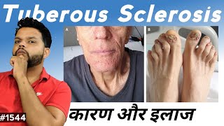 Tuberous Sclerosis Causes Symptoms amp Treatment In Hindi [upl. by Okimuy]