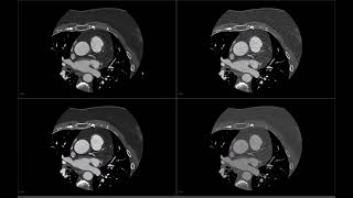 Cardiac CT AI vs Iterative noise reduction [upl. by Aicnarf948]