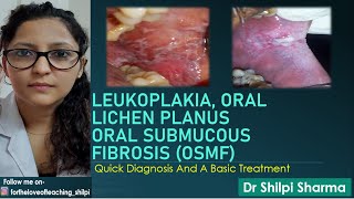 Quick Diagnosis And Basic Treatment of Leukoplakia Lichen Planus and Oral Submucous Fibrosis OSMF [upl. by Erodoeht]