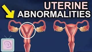 How can you tell if your uterus is causing infertility or miscarriage [upl. by Enelkcaj]