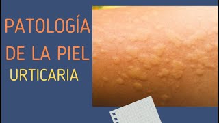 6 URTICARIA [upl. by Ila]