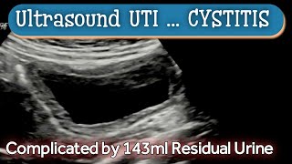 Cystitis  UTI  Ultrasound  Diagnosis [upl. by Wernher454]