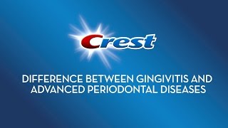 Difference between Gingivitis and Advanced Periodontal Diseases  Crest [upl. by Shelagh601]