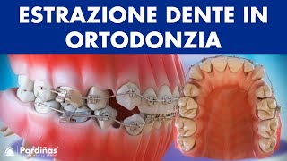 Estrazione dente in ortodonzia © [upl. by Narik]