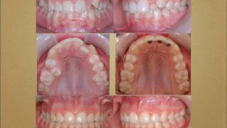 Cas traités en orthodontie orthodontistes Lemaymov [upl. by Rolo]