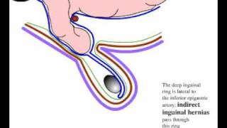 Direct and indirect inguinal hernia [upl. by Edgardo]