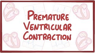 Premature Ventricular Contraction  causes symptoms diagnosis treatment pathology [upl. by Laehcym]