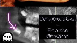 Dentigerous Cyst Removal with Extraction of Involved Impacted Molar drwahan [upl. by Bromley]