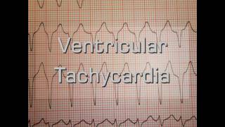 Ventricular Tachycardia [upl. by Sidney890]