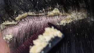 Dandruff scratching removal on head using black combing138 [upl. by Einitsed]