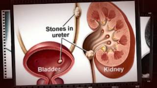 renal calculi symptoms and causes [upl. by Bobby]