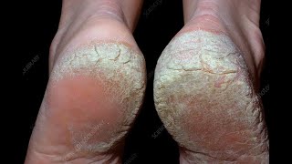 Palmoplantar Psoriasis Dos amp Donts  உள்ளங்கால் சொரியாசிஸ் சவால்  Dr Selvin [upl. by Hedley]