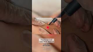 Fractional CO2 Laser Before And After Mole Removal foryou [upl. by Leahicm]