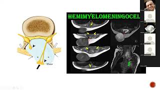 Spinal dysraphism lecture [upl. by Odom]