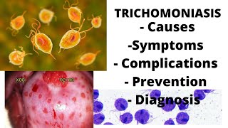 Trichomoniasis  symptoms causes complications prevention amp diagnosis [upl. by Dail]