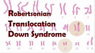 Robertsonian Translocation Down Syndrome ROB [upl. by Atwekk]