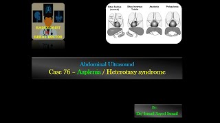 Ultrasound Case 76 Asplenia  Heterotaxy Syndrome [upl. by Oruhtra]