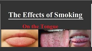 The Effects of Smoking on the Tongue [upl. by Akinal]