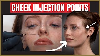 The Best Cheek Filler Injection Points  Where to inject the cheek for beautiful results [upl. by Martreb]