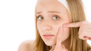 What Are Home Remedies That Work  Acne Treatment [upl. by Rivalee]