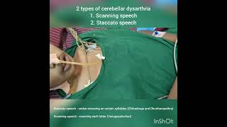 Cerebellar dysarthria  Scanning speech and Staccato speech  DrKamaleshTNMediCalLectures [upl. by Gui]