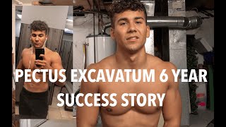 Pectus Excavatum  6 Year Successful Transformation Without Surgery [upl. by Alyahs]