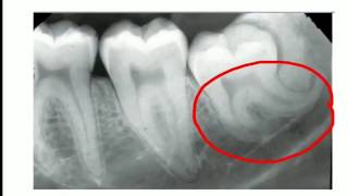 quotDILACERATIONquot DEVELOMENTAL DISTURBANCE OF TEETH QUICK RECAP FOR DENTAL STUDENTS [upl. by Sarge]