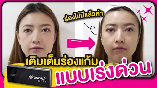 Cosmo Clinic  Filler ร่องแก้มด้วย Neuramis Deep [upl. by Sibylla]