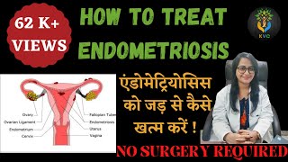 Treatment Of Endometriosis Without Surgery  Causes And Symptoms Of Endometriosis Hindi [upl. by Iram]