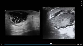 Cellulitis vs abscess [upl. by Aisereht]