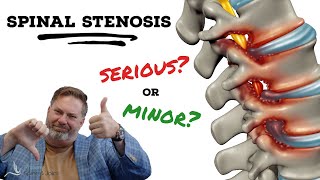 Is Spinal Stenosis serious  The Clinic Episode 1 [upl. by Ynnattirb]