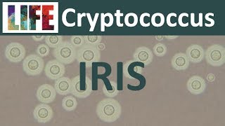 Cryptococcal IRIS [upl. by Anurb746]