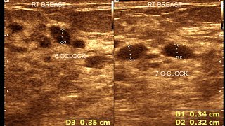 Duct ectasia breast  Axilla Enlarge Lymph Node [upl. by Starla]