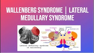 Wallenberg Syndrome  Lateral Medullary Syndrome  PhysiotherapyKnowledge [upl. by Abercromby]