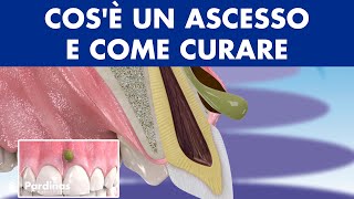 ASCESSO dentale  Cosè un flemmone e come CURARE linfezione dei denti © [upl. by Falo422]