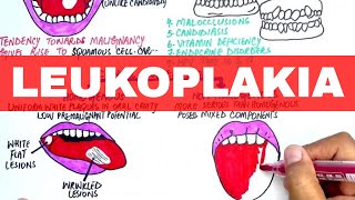 Leukoplakia  Causes Diagnosis amp Treatment [upl. by Trelu]