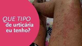 Que tipo de urticária eu tenho [upl. by Ezarra]