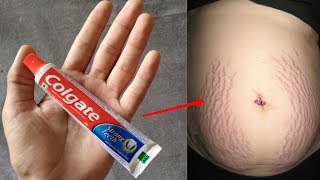 सिर्फ चंद मिनिटो में STRETCH MARK ऐसे दूर कर देगा ये  How to Remove Stretch Marks Fast [upl. by Aramot]