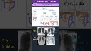 Segmental Analysis Approach to Congenital Heart Diseases [upl. by Arvad]