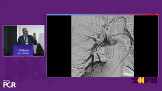 Advancing percutaneous treatment of pulmonary embolism with computerassisted vacuum thrombectomy [upl. by Cappella]