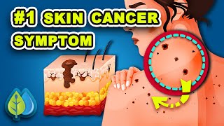 Skin Cancer Symptoms  1 Symptoms of Skin Cancer People Ignore [upl. by Rhona]