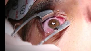 Corneal Iontophoresis Procedure [upl. by Dnomyad416]