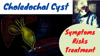 Choledocal Cyst Symptoms Classification Risks Treatment [upl. by Cherin]