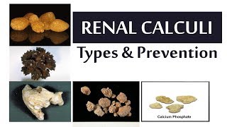 Renal Calculi Types and Prevention [upl. by Hilario]