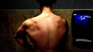 POV BACK DAY WITH ACNE [upl. by Hterrag]