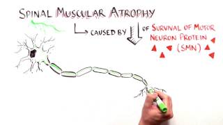 Cut and Paste Treating Spinal Muscular Atrophy with Nusinersen [upl. by Lila487]