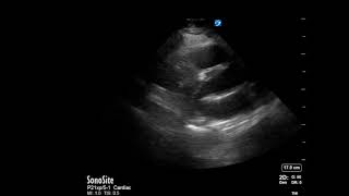 Right Ventricular Dilation Submassive PE Ultrasound Parasternal long [upl. by Ycnalc]