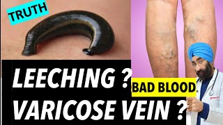 Can Leeching detox body amp Cure Varicose veins  hirudotherapy  DrEducation [upl. by Schaab468]