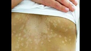 Tinea Versicolor Fungal infection Sehua का सही इलाज। Dr Sandesh Gupta Dermatologist [upl. by Taam]